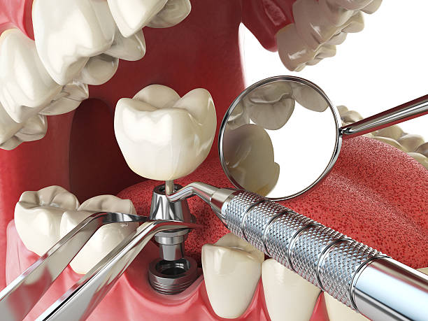Best Emergency Dental Care for Broken or Chipped Teeth in Gilmer, TX